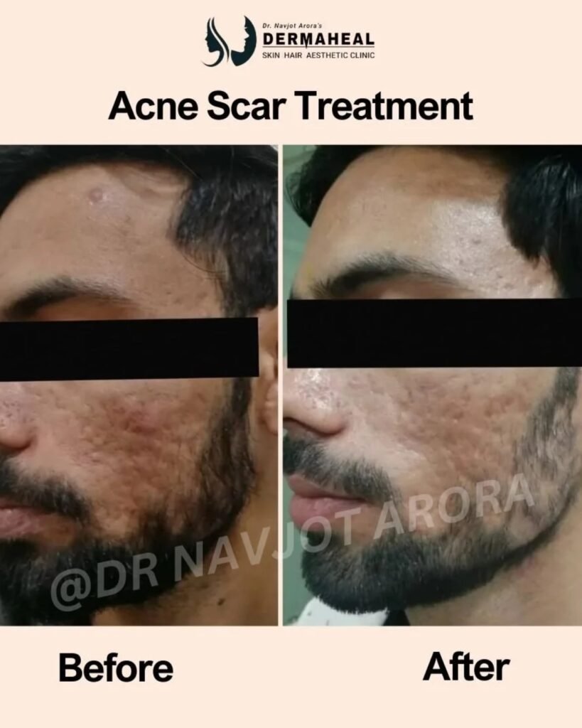 acne scars reduction