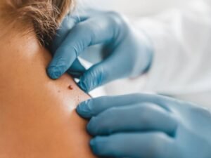 skin tag removal in Dwarka