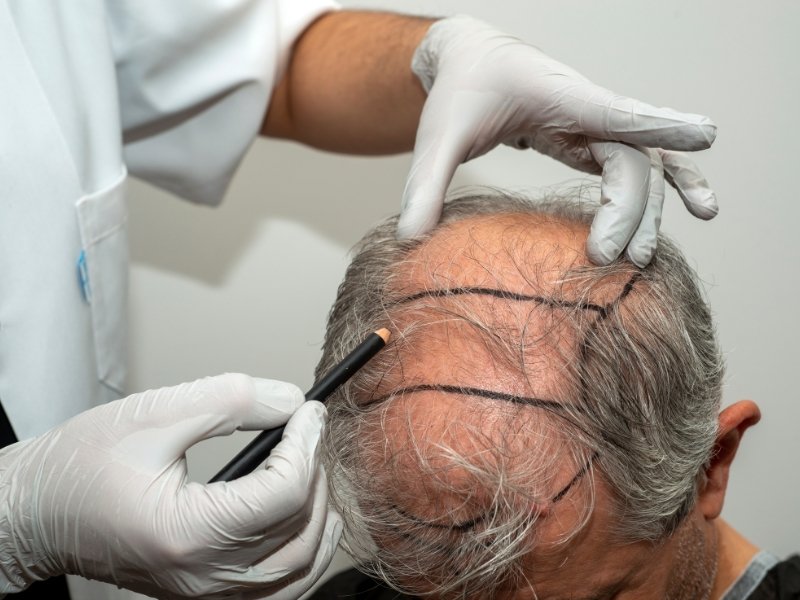 Hair Transplant in Dwarka: 7 Powerful Benefits You Should Know