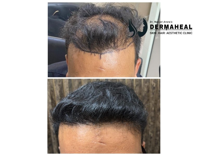 Transform Your Hair with the Best Hair Transplant in Dwarka