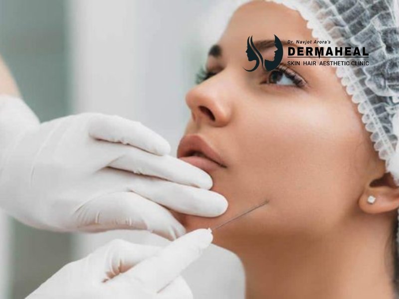 5 Amazing Benefits of Thread Lifting in Dwarka for Youthful Skin